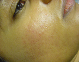 acne treatments glasgow