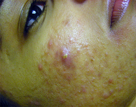 acne treatments glasgow
