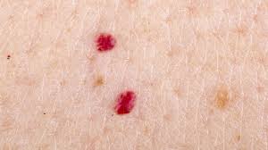 blood spots treatment in Glasgow