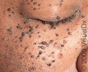 dermatosis papulosa treatment in Glasgow