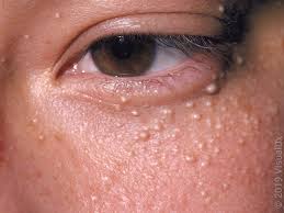 milia removal in Glasgow
