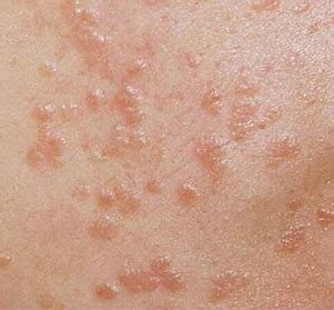 mixed blemishes treatment in Glasgow