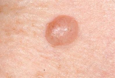 mole reduction in Glasgow