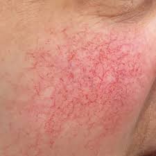 red vein removal in Glasgow