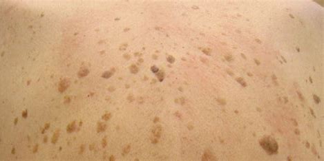 sebaceous hyperplasia treatment in Glasgow