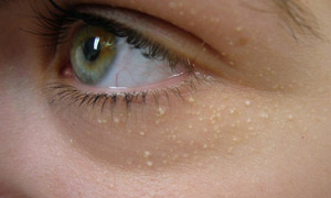 milia removal in Glasgow