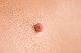 skin tag removal in Glasgow