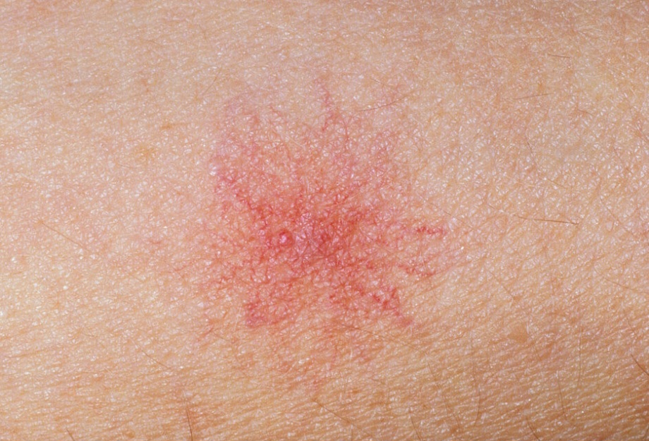 spider naevi treatment in Glasgow