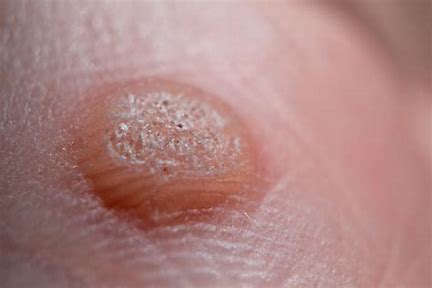 warts treatment in Glasgow