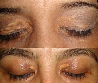 xanthelasma treatment in Glasgow